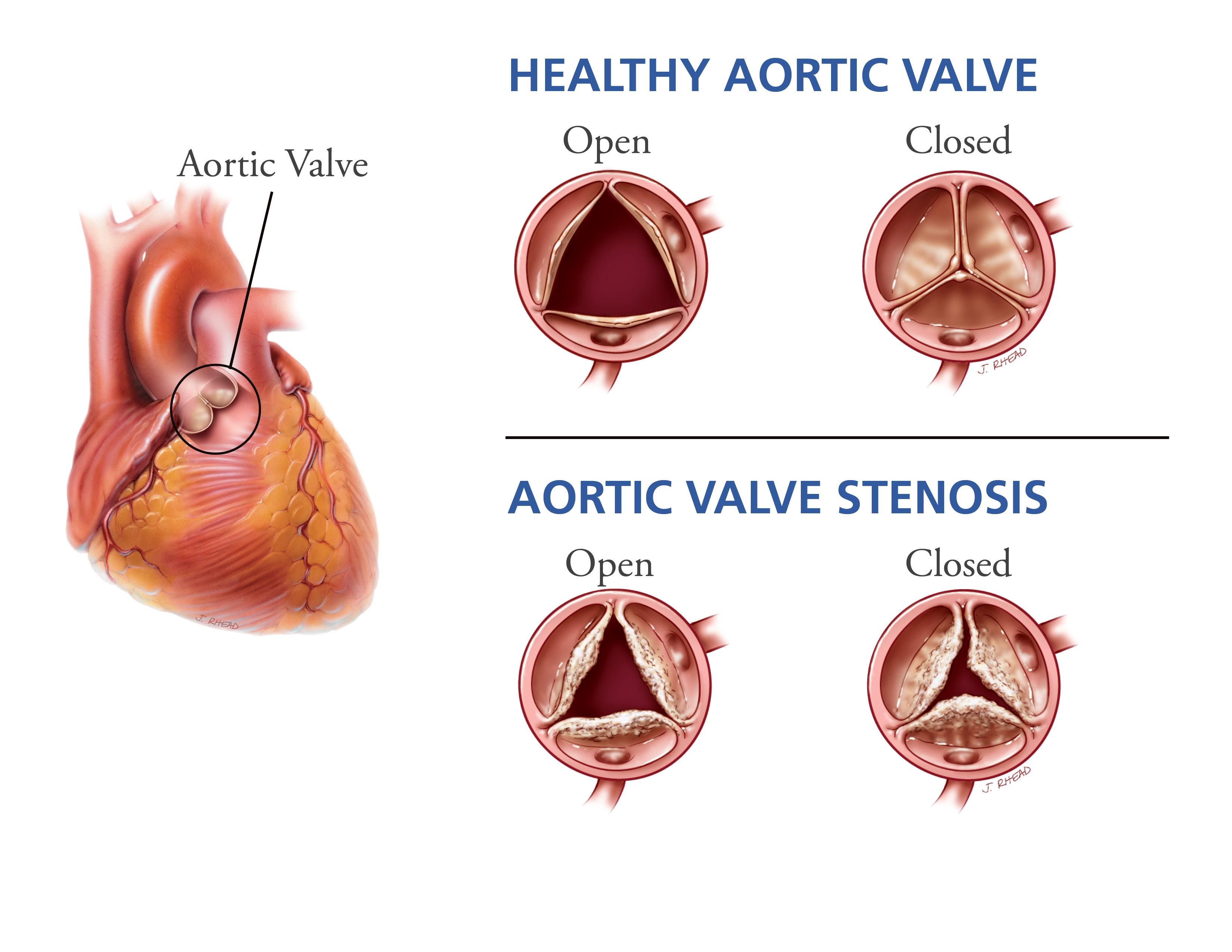 A Tale Of Two Diseases Decoding Aortic Stenosis And Cardiac Amyloidosis A Tale Of Two Diseases Decoding Aortic Stenosis And Cardiac Amyloidosis